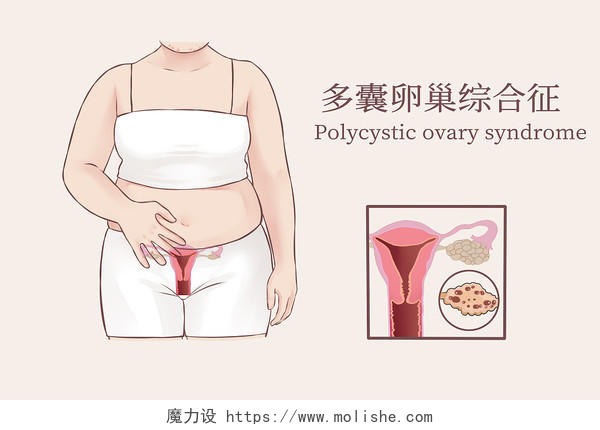 写实风女性子宫多囊卵巢综合征示意图医疗插画
